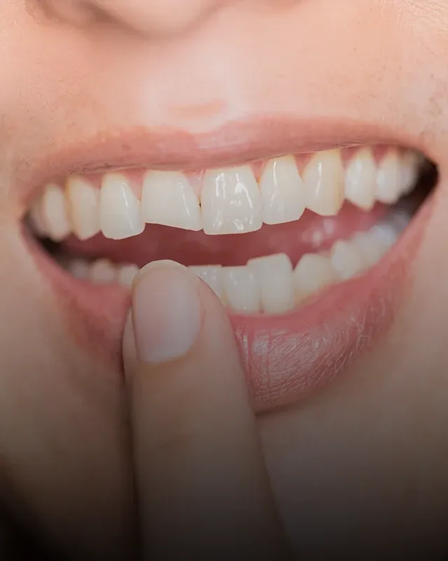 A patient pointing to their broken front tooth