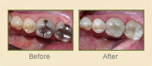 Before and After photos of composite fillings