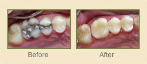 Before and after photos of conservative crowns