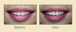 Before and after photos of cosmetic dentistry services