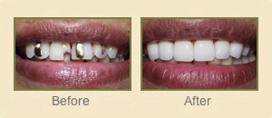 Before and After photos of porcelain crowns