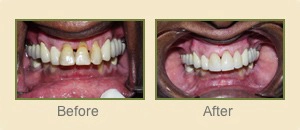 Before and After photos of a smile restoration